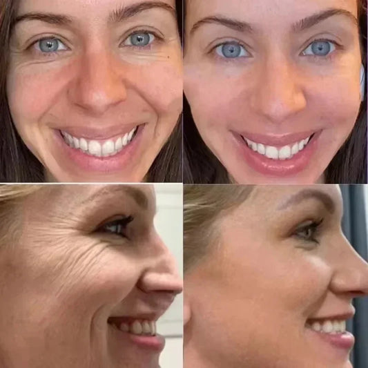 Youthful Glue-Free Lift Patches – Say Goodbye to Fine Lines!